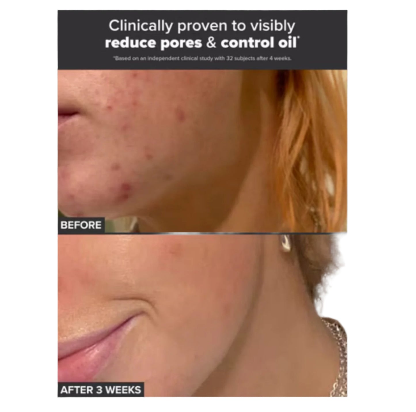 image showing before and after of using Paula's Choice 2% BHA Liquid Exfoliant for enlarged pores and uneven skin tone available for delivery in Karachi, Lahore, Islamabad across Pakistan