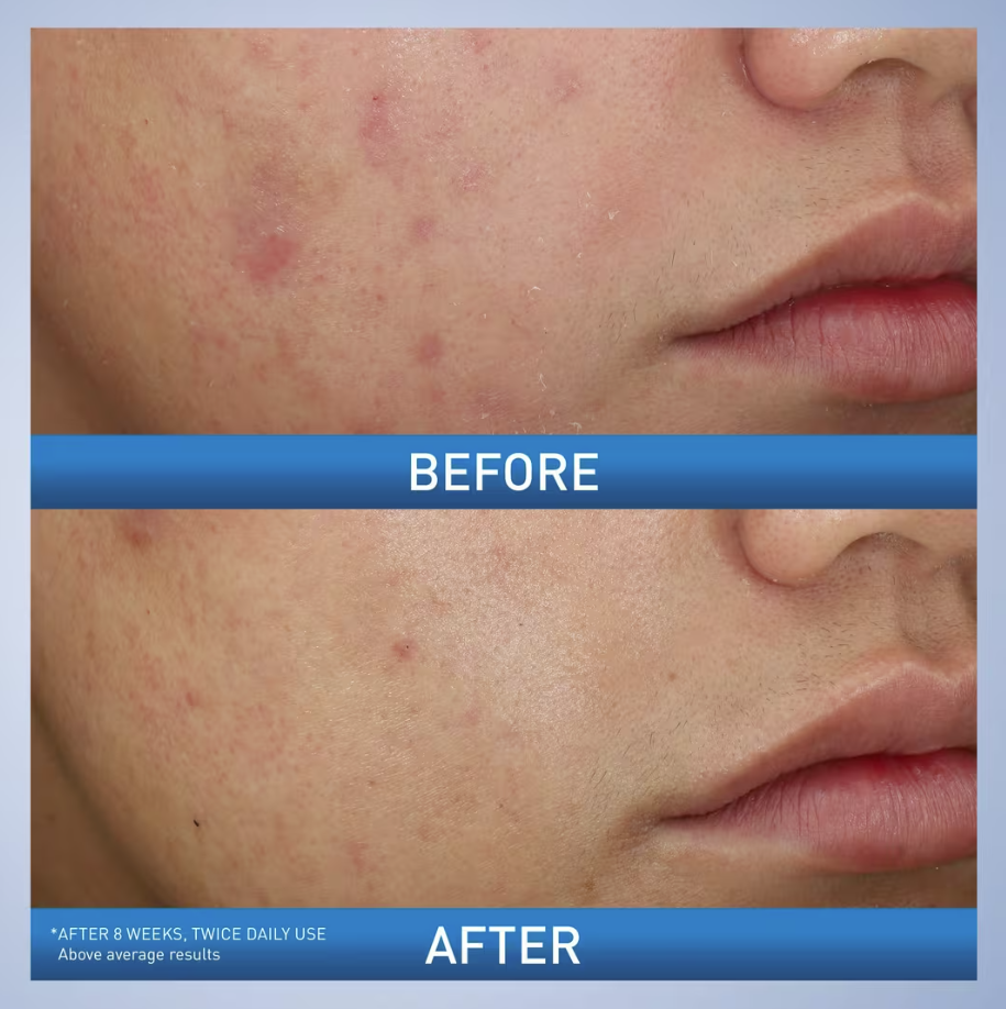 image showing before and after of using CeraVe Acne Foaming Cream Wash for acne and pimples available in Pakistan