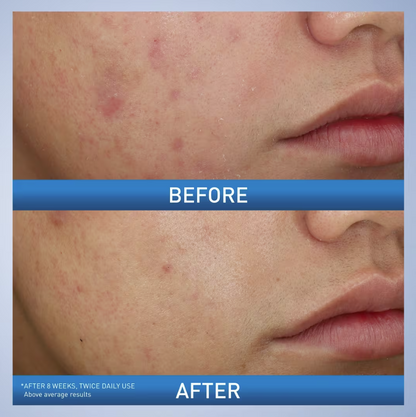 image showing before and after of using CeraVe Acne Foaming Cream Wash for acne and pimples available in Pakistan
