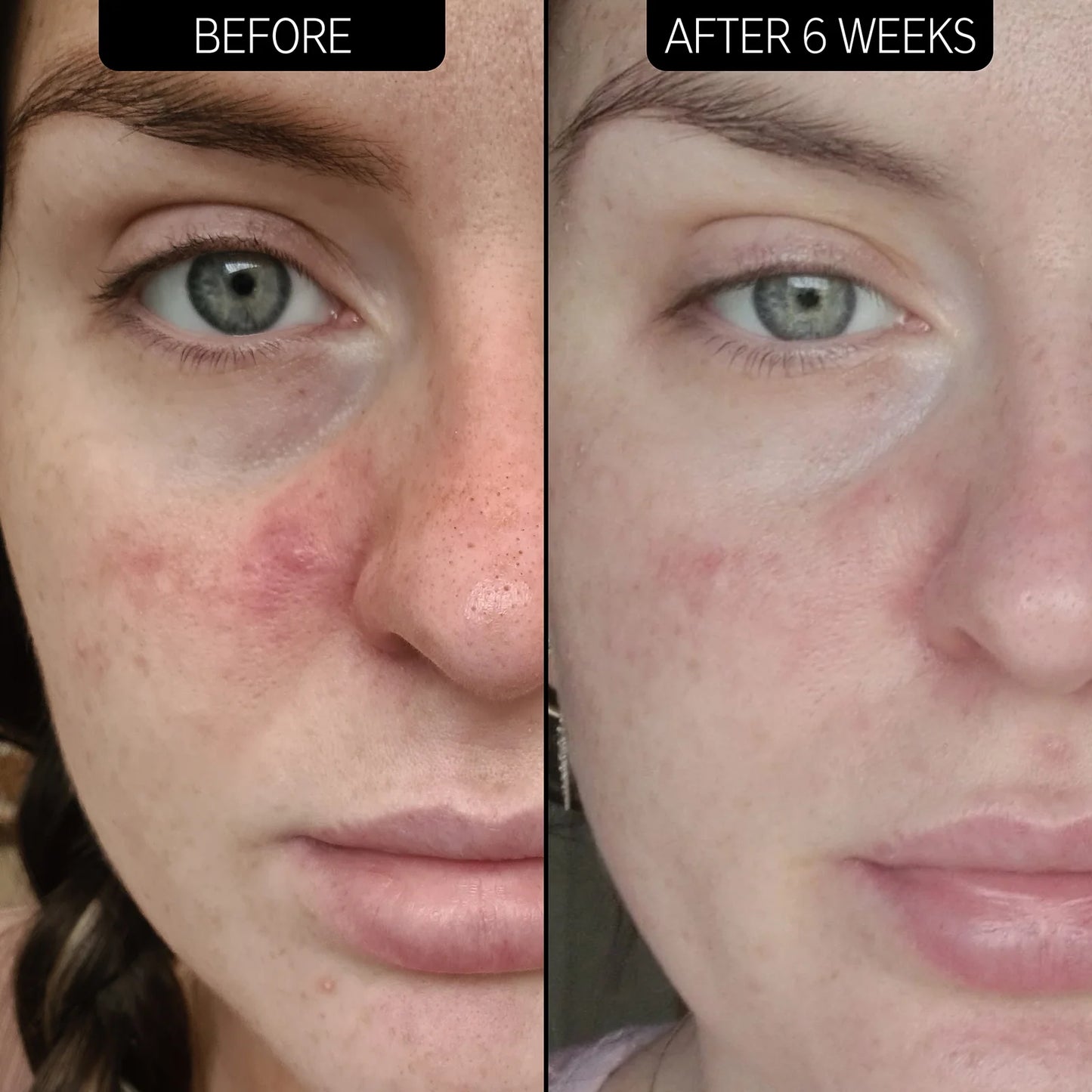 image showing before and after of using azelaic acid serum available at Heygirl.pk for delivery in Pakistan