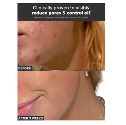 image showing before and after of using Paula's Choice 2% BHA Liquid Exfoliant for enlarged pores and uneven skin tone available for delivery in Karachi, Lahore, Islamabad across Pakistan
