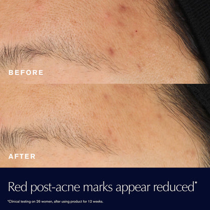 before and after result of using Estee Lauder Advanced Night Repair Rescue Solution for Skin Redness and post-acne marks for her available at Heygirl.pk in Pakistan.