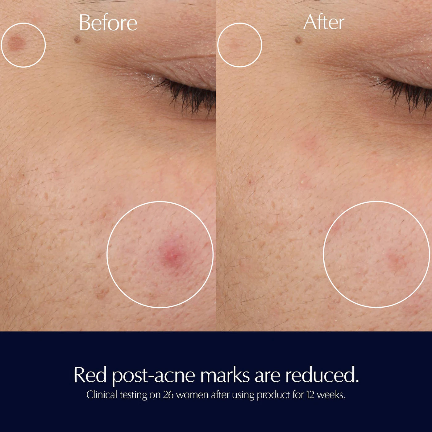 before and after result of using Estee Lauder Advanced Night Repair Rescue Solution for Skin Redness and post-acne marks for her available at Heygirl.pk in Pakistan.
