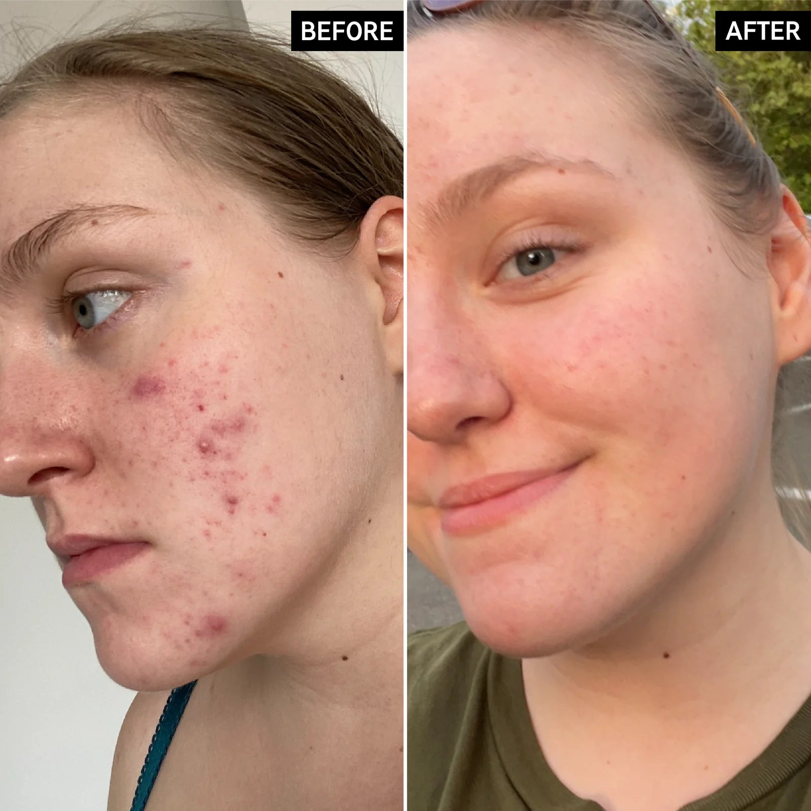 image showing before and after of using glycolic acid toner for open pores, fine lines and blackheads available at Heygirl.pk for delivery in Pakistan