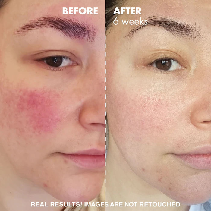 image before and after of girl using Huda Beauty PHA foaming cleanser for normal to oily skin available at Heygirl.pk for delivery in Pakistan