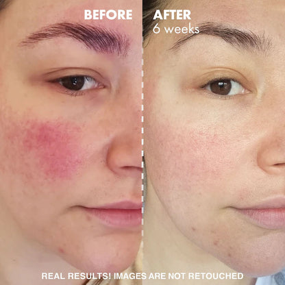 image before and after of girl using Huda Beauty PHA foaming cleanser for normal to oily skin available at Heygirl.pk for delivery in Pakistan