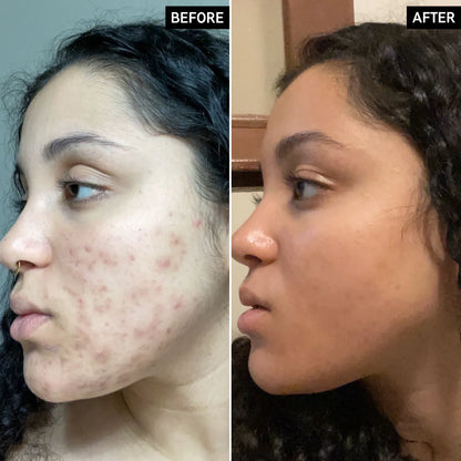 image showing before and after results of Pakistani girl after using inkey tranexamic acid serum available at Heygirl.pk for delivery in Pakistan