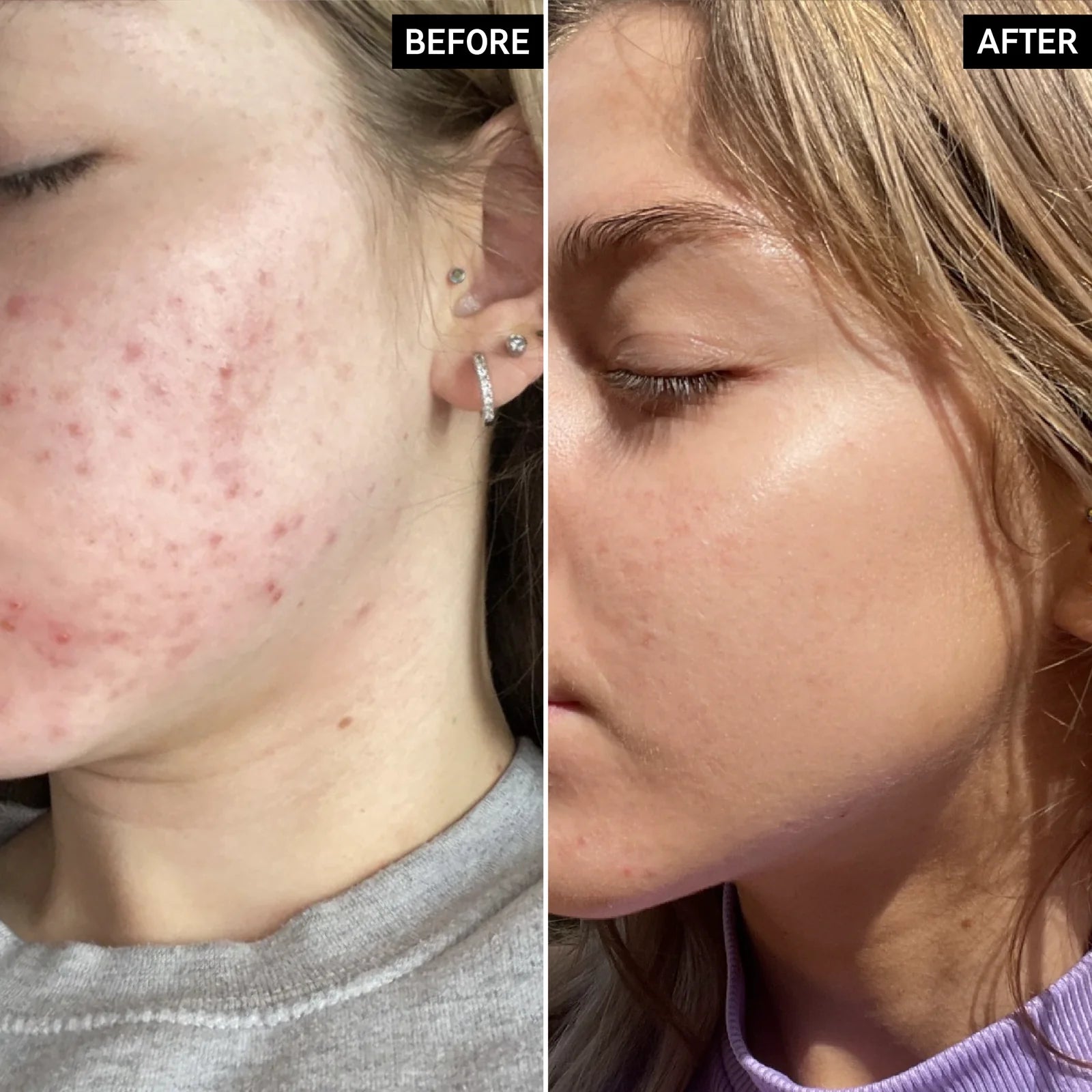 image showing before and after results of inkey niacinamide available at Heygirl.pk for delivery in Pakistan