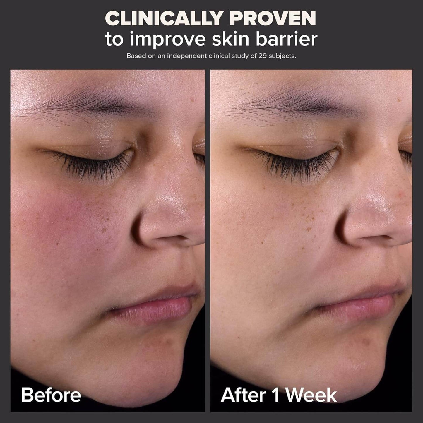 image showing before and after of using Paula's Choice 2% BHA Liquid Exfoliant for enlarged pores and uneven skin tone available for delivery in Karachi, Lahore, Islamabad across Pakistan