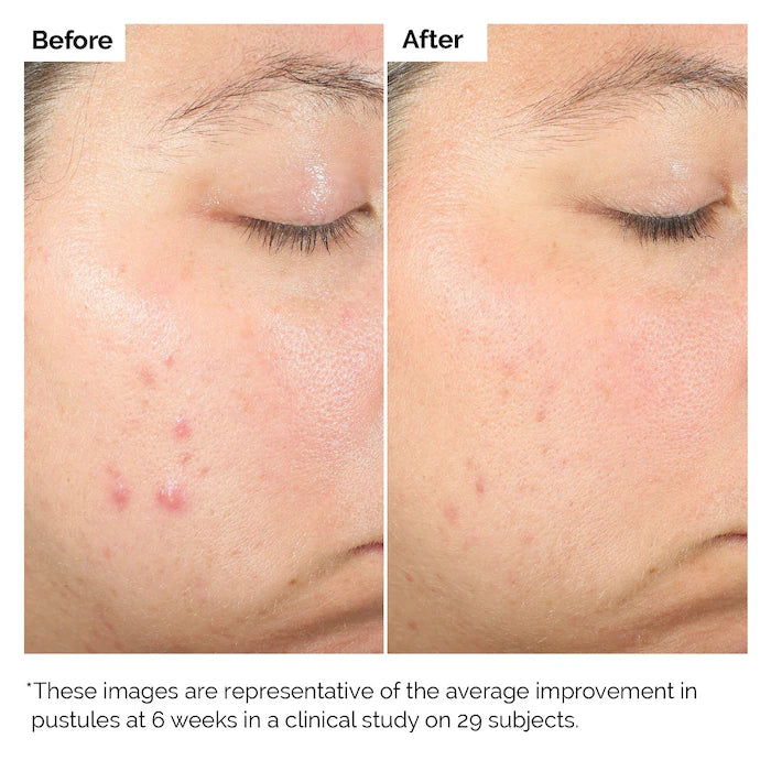 image showing before and after benefits of using Ordinary Salicylic Acid 2% Solution for acne and blemishes now available at Heygirl.pk in